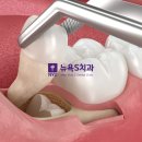 맨해튼치과의원 | 종로 사랑니 발치 치과, 어디서 해야 할지 고민된다면 이것부터 확인하세요