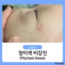 장미색 비강진 얼굴 증상 번짐 후기