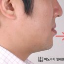 토미치과의원 | 주걱턱 양악수술 없이 얼마나 좋아지나요? (교정치과 치료 후기)