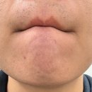 메티의원 | [내돈내산내아픔] 남성 레이저제모 메티의원 2회차 후기