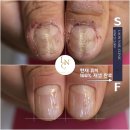 판교동612-5 | &#34;두껍게 자라는 손톱&#34;의 원인은 &#34;손톱진균&#34; 무좀과 달라요