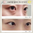 [압구정 성형외과] 눈밑지 수술없이 시술로 눈밑지방 다크서클 해결! 림피드 인생주사 찐 후기