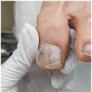 로다샵 | 목포발톱무좀, 로다풋케어에서 되찾은 건강한 발의 자신감