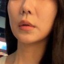 땅콩짐 | 압구정역피부과 땅콩형 얼굴 시술 튠페이스 솔직 후기 | 써마지 티타늄 효과 비교