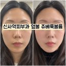 신사약국 | 신사역피부과 땅콩형 얼굴 쥬베룩볼륨 옆볼 8cc 시술 후기