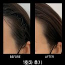 헤어완성 | 강남 헤어라인 :: 댓스칼프 :: 팡팡이 없이도 자연스러운 헤어라인 완성 후기