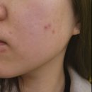 옐로우연화 | 부천 상동 에스테틱 여드름 관리 여드름케어 압출후기 [솔에스테틱]