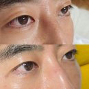 압구정성형외과 남자 절개 쌍꺼풀수술 안검하수 눈매교정 6개월 리얼변화(후기, 붓기, 가격 Q&amp;A)