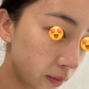 데이즈피부과의원 | 엑셀브이 + 백옥주사 600mg l 안산 데이즈 피부과 ㅣ 고잔동 피부과 ㅣ 피부과 전문의 1명 ㅣ 내돈내산