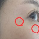 자연과한의원 인천점 | Beauty 3. 인천/구월동 편평사마귀제거(거우침 시술) - 화접몽한의원(인천점)
