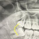 오제석치과의원 | [광주 오치동 오제석 치과] 사랑니 발치 후기 🦷🪥 / 광주 사랑니 잘 뽑는 치과 / 사랑니 발치 후 먹은...