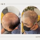 평택수앤뷰티) 무더운 여름 시작에 답답한 가발을 벗어나고 싶다면 ? &#34;평택두피케어&#34; 후기