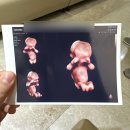 리필업의원 | 🍼👣임신 8W~12W : 난임병원 졸업•분만병원 전원•임신 초기 증상•태아보험 가입•1차 기형아 검사...