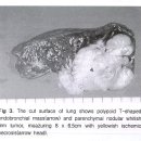 폐 수술 후의 잘라낸 암 사진 이미지