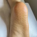 포항시남구66 | 비올라 푸스케어 포항효자점 :: 발뒤꿈치 발각질 제거 후기