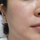 600 | 안양리프팅 고민하다 받은 덴서티 알파 600샷 후기 (통증,다운타임,붉은기)