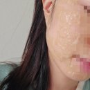 보드미 | 합정 연세보드미의원 편평사마귀 제거 내돈내산 후기 (1~5일차 &amp; 한달 후)