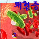 사암침, 사암침법 - 패혈증 치료 방법 - 비과학적 양의학 118 이미지