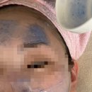 228약국 | (내돈내산) 포항 피부과 추천(발품 팔아 찾은 찐 후기)_ LDM 물방울 리프팅(MED-TRI) 관리 후기 2편