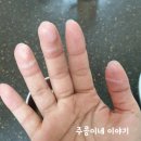 부평안병원 | 190703 감사일기 :: 손가락화상 응급처치로 키토산+바세린