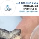 역대급 두껍고 변형된 내성발톱 제거해드렸어요 ㅠ 어떻게 지금까지 버티셨는지.. #발톱제거 이미지