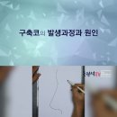 코수술하면 구축오는 이유 이미지