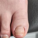 내일도;네일해 | 대구 서구 ‘내일도네일해’ 내성발톱 관리 후기