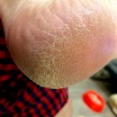 고운님 전통차 | 고운발 풋크림 다이소 발각질제거기 액상 우레아 후기