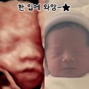 내사랑땡구 | 땡구일기10. 땡구를 만났다!(feat. 삼성미즈 제왕절개 후기, 필수준비템, 생생한 통증 후기)
