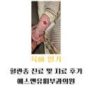 신영약국 | 혈관종 진료 및 치료 후기!(feat. 에스앤유피부과)