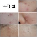 메가202디자인 | <메가돔약국> 더마틱스 리페어 스팟패치 2종 사용 후기
