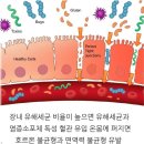 뇌전증 완치 판정 사례 간질 완치법 치료법 이미지