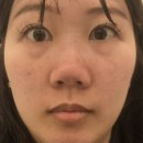 오한의원 | 수원 모공 인계동 모공치료잘하는곳 메디컬오 한의원 모공리액터 2회차 후기!