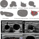 SONOGRAPHIC IMAGING AND APPEARANCE OF LNs 이미지