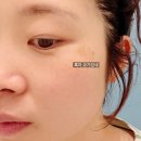고려제일주유소 | 대구 흑자제거 리팟레이저 1회 후기 전후 효과 실화? (내돈내산)