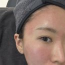 에스디피부과 | 강남피부과 포텐자 내돈내산 후기 여드름 모공 솔직 후기