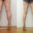 O.S 메디칼 | #84. [의료 칼럼] 고용량 종아리보톡스 시술의 역설: 내성 위험과 정밀 진단의 임상적 가치 - 세이지의원