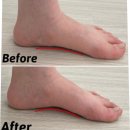 슈즈클리닉 운동화빨래방 | 족저근막염 치료 병원 방문전 해봐야하는 것