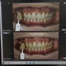 달미르 | [W.06] 🦷 대구 치아미백 ｜ 대구 전문가미백 한달뒤 후기 ｜ 대구미르치과🦷