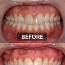 이랑치과기공소 | 앞니 라미네이트 가격포함 6년 후기(치료방법,부작용 사례
