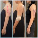 멍때려 | [천호 다이어트] 팔 지방추출주사 당일 멍, 붓기 찐 후기!