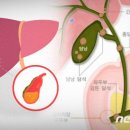 담즙 찌꺼기가 몸 속 돌덩이로…"콜레스테롤 담석 주의 필요" 이미지