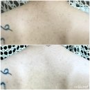 오름한의원 | [대구/중구] 여드름전문한의원에서 등드름 오름테라피 6~9회차 후기