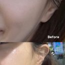 사진병원 | 마포구 쥬베룩 스킨부스터 잘하는 병원 내돈내산 후기(전,후 사진 비교)