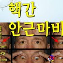 핵간 안근마비 치료 방법 - 사암침법, 사암오행침, 오행침, 정통사암침 이미지