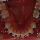 슬기롭고아름다운치과교정과치과의원 | [서초 방배 교정전문 시크릿치과]잇몸뼈 돌출을 동반한 입돌출 환자의 교정치료기