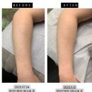 알라딘한의원 | 마곡발산 바디 알라딘필링 후기 | 팔 모공각화증, 여드름 흉터, 색소침착 3회 시술 전후 변화