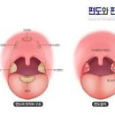 편도결석 빼는법 냄새 병원 가면 되나요? 이미지