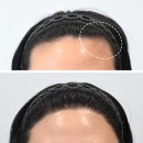 병원1 | 강남모발이식병원 헤어라인 1년 변천사 후기 (Before &amp; After 포함)