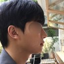 오블리성형외과의원 | 남자 낮은코성형, 콧대는 필요한 부분만 높이고 코끝은 자가연골로 자연스럽게